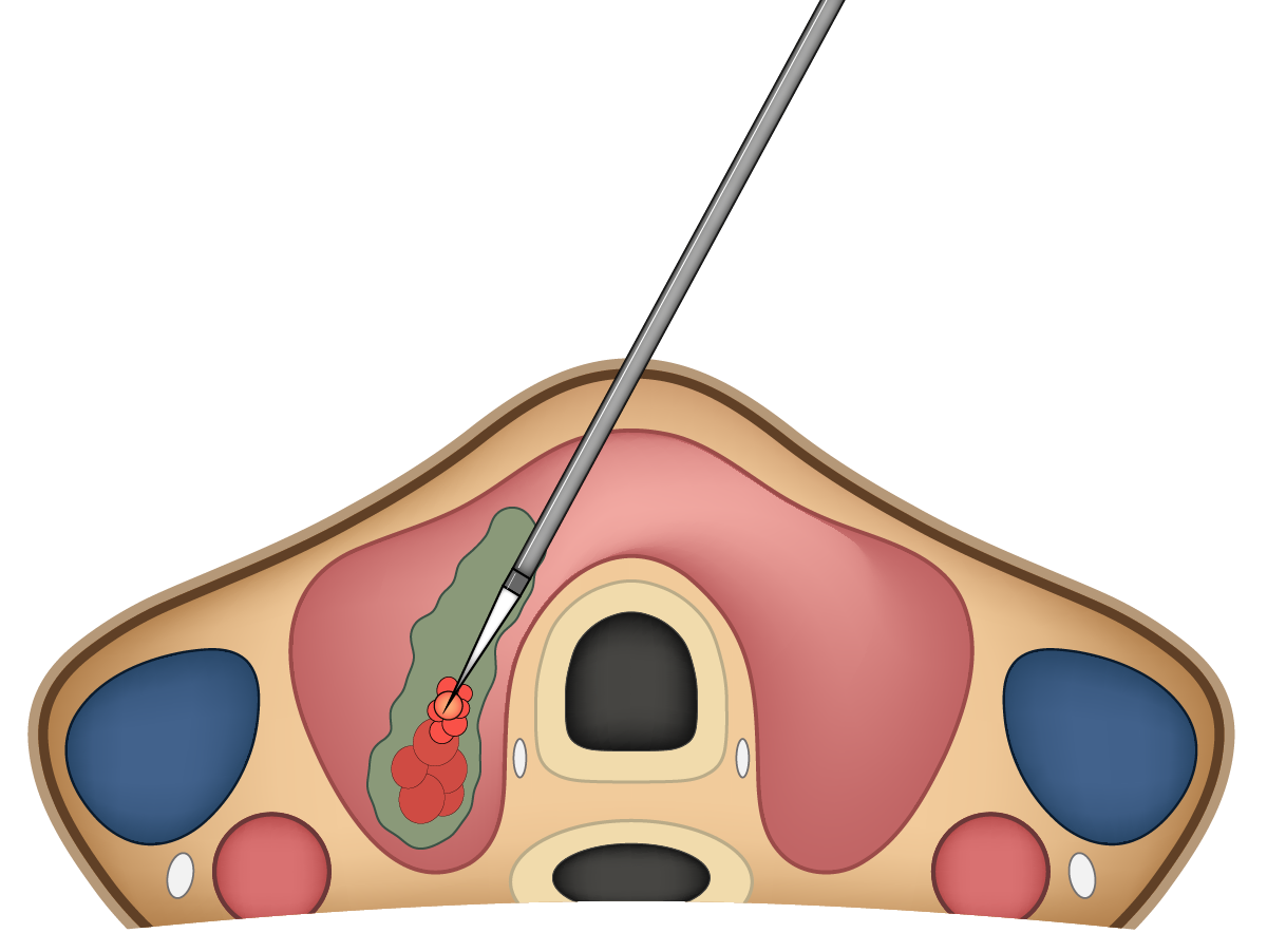 Grafik: Illustration der Elektrodenführung in der Schilddrüse Grafik: Illustration der Elektrodenführung in der Schilddrüse